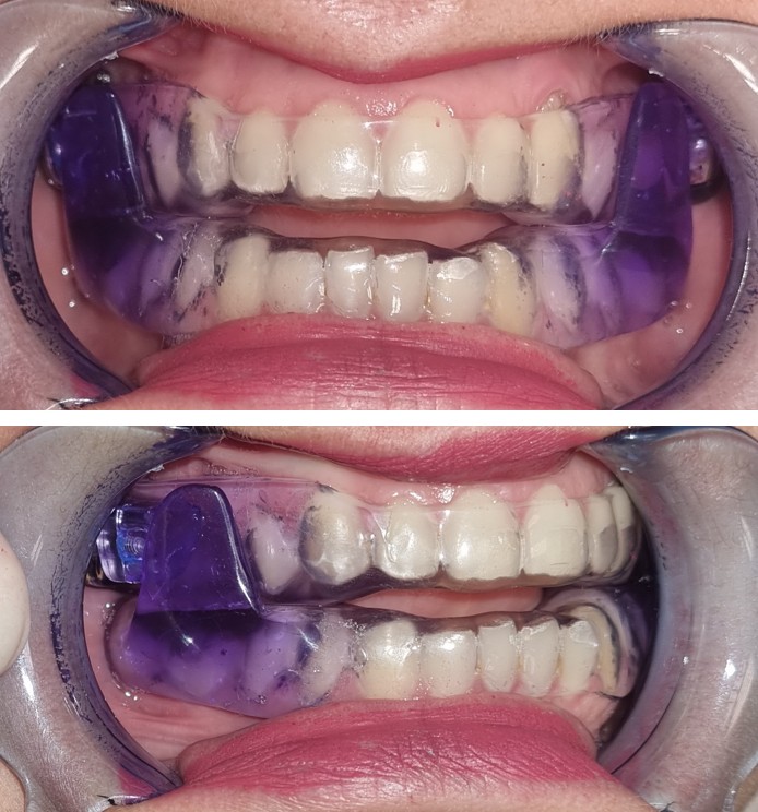 Aparelho intraoral de avanço mandibular em posição sobre os dentes, em vista frontal e vista lateral