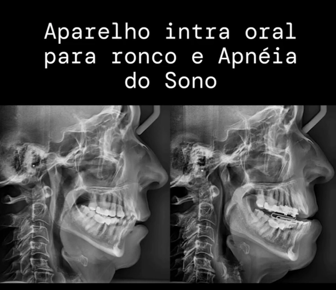 Radiografias laterais comparando a via aérea sem e com aparelho intraoral em boca