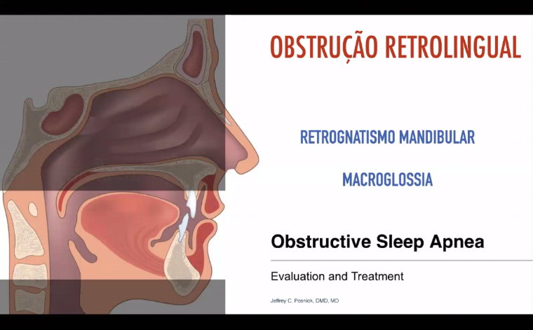 Ilustração anatômica da região retrolingual e de fatores que podem reduzir o espaço atrás da língua