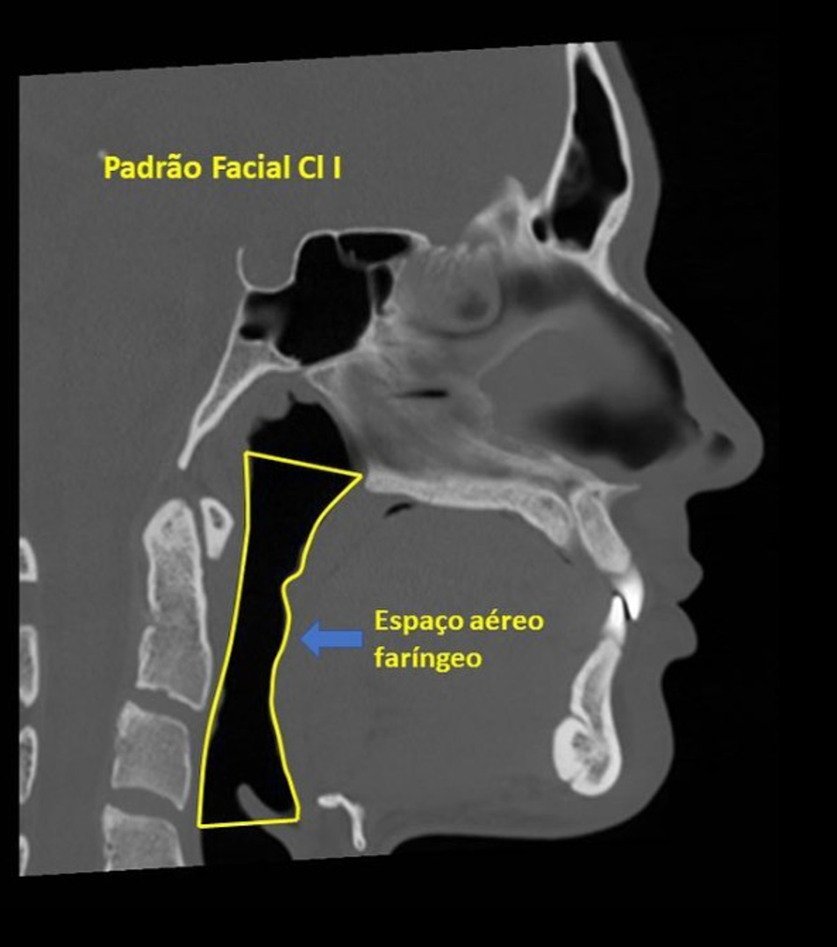 Tomografia de perfil mostrando espaço aéreo faríngeo em padrão facial classe 1