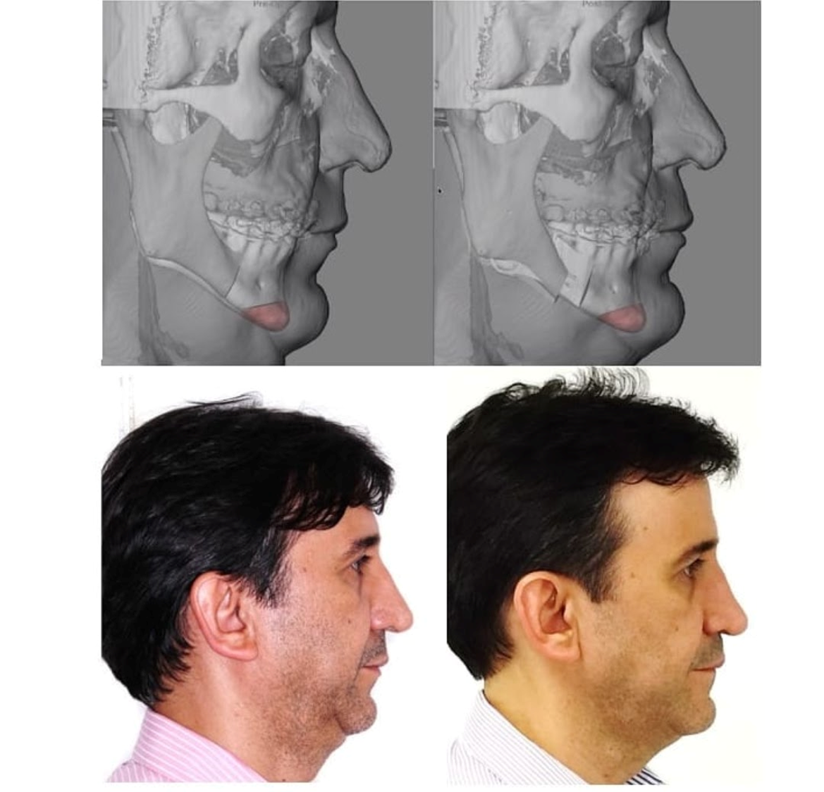 Planejamento virtual e comparação de perfil antes e após avanço maxilomandibular