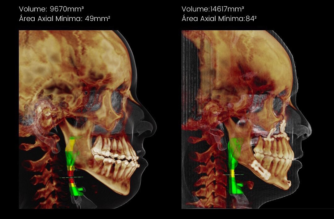 Comparação tomográfica do volume e da área axial mínima da via aérea antes e após cirurgia ortognática