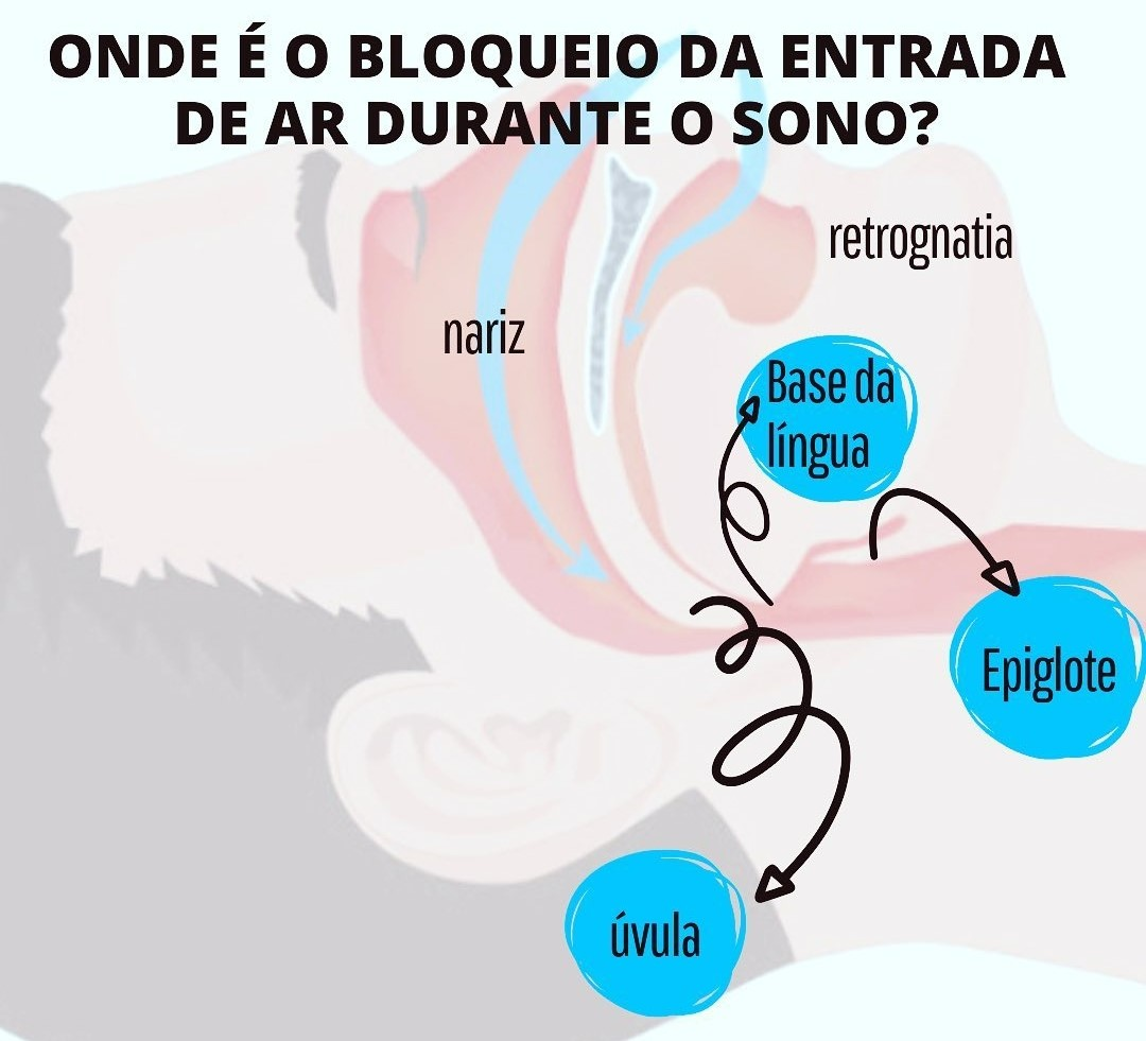 Ilustração dos possíveis pontos de bloqueio da passagem do ar durante o sono