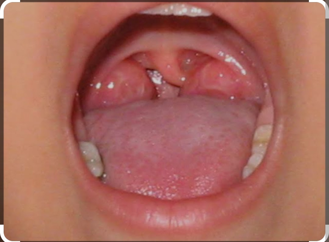 Fotografia clínica da cavidade oral usada na avaliação da orofaringe