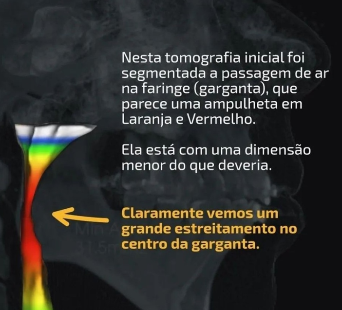 Tomografia inicial com estreitamento da passagem de ar na faringe