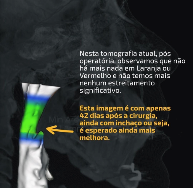 Tomografia pós-operatória mostrando ampliação da passagem de ar na faringe