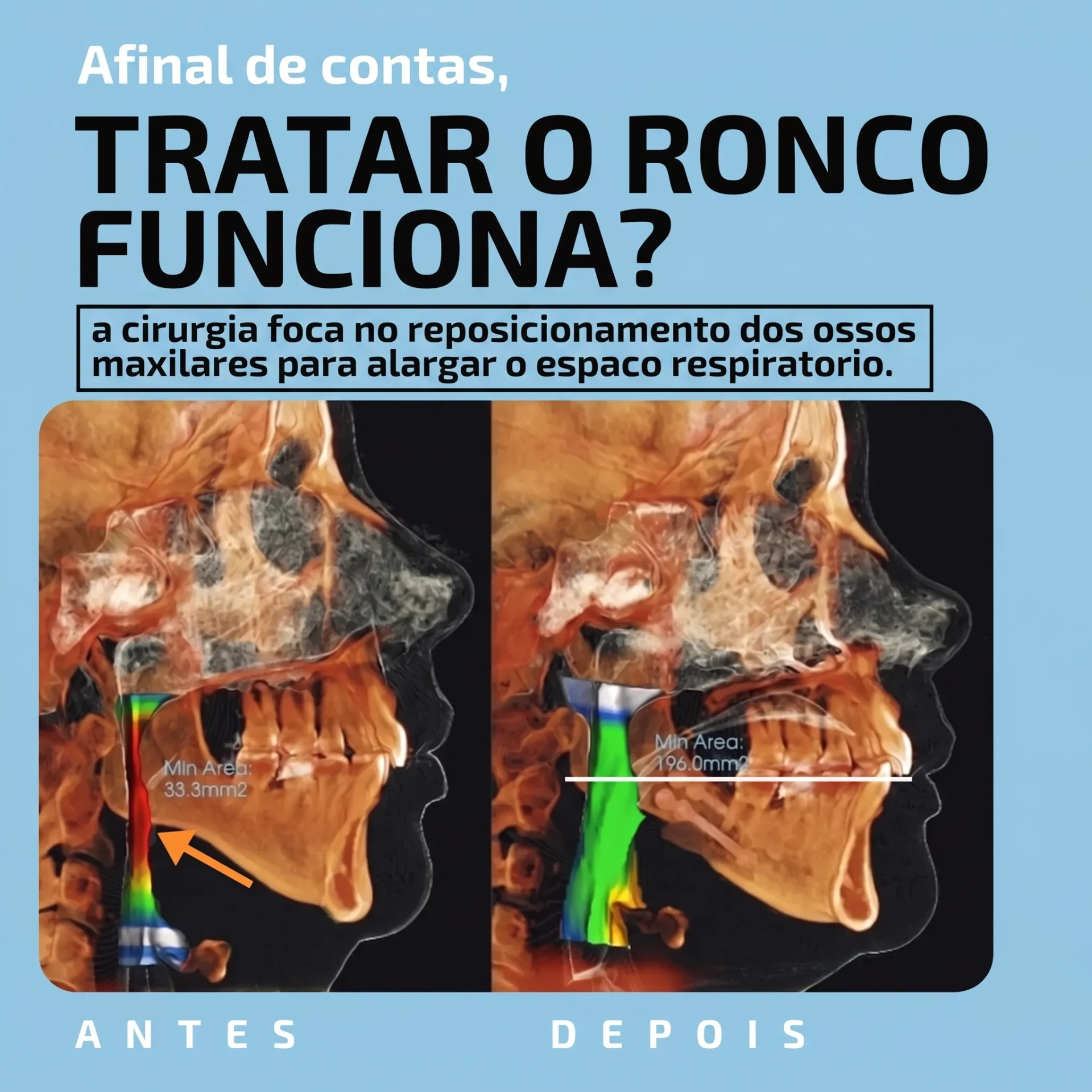 Tomografia antes e depois da cirurgia ortognática mostrando aumento da área mínima da via aérea de 33,3 mm² para 196,0 mm²