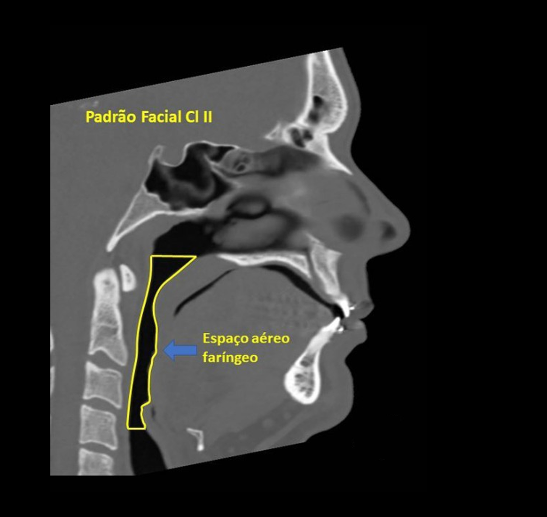 Tomografia de perfil mostrando espaço aéreo faríngeo reduzido em padrão facial classe 2