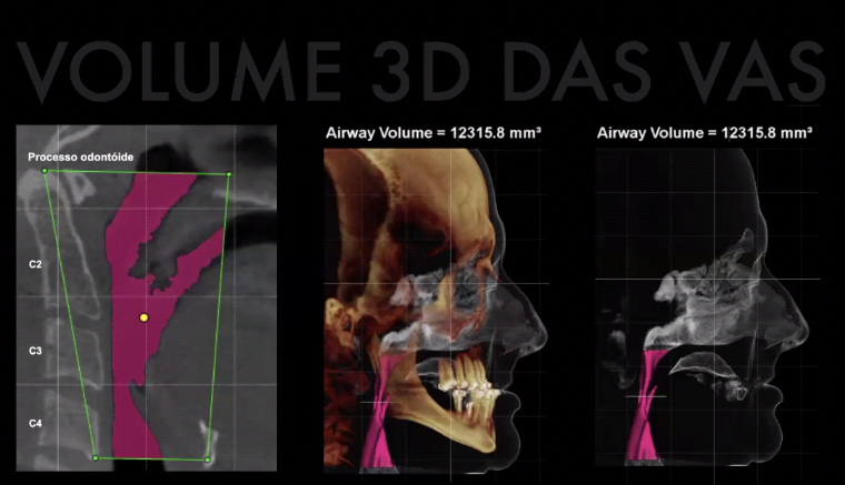 Análise tridimensional do volume das vias aéreas em imagens craniofaciais