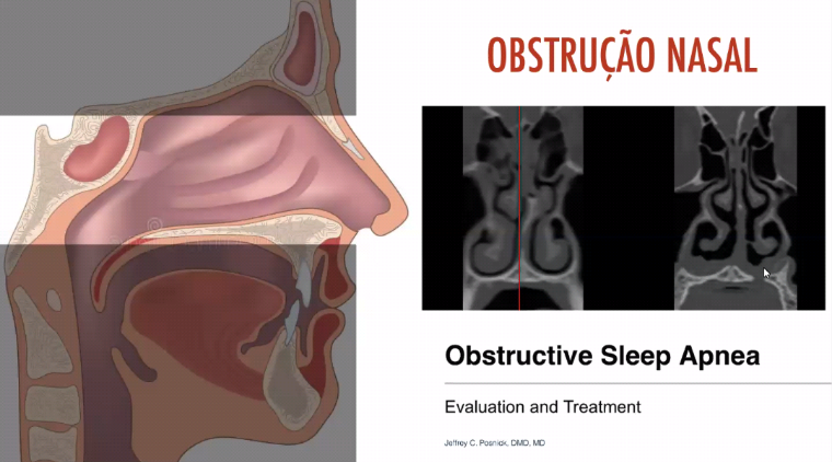Ilustração anatômica e cortes tomográficos usados na avaliação da obstrução nasal