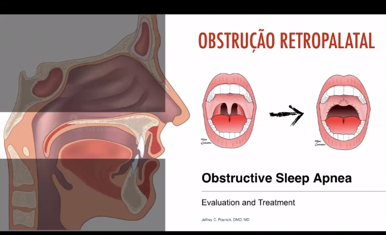 Ilustração anatômica da região retropalatal e de possível estreitamento atrás do palato